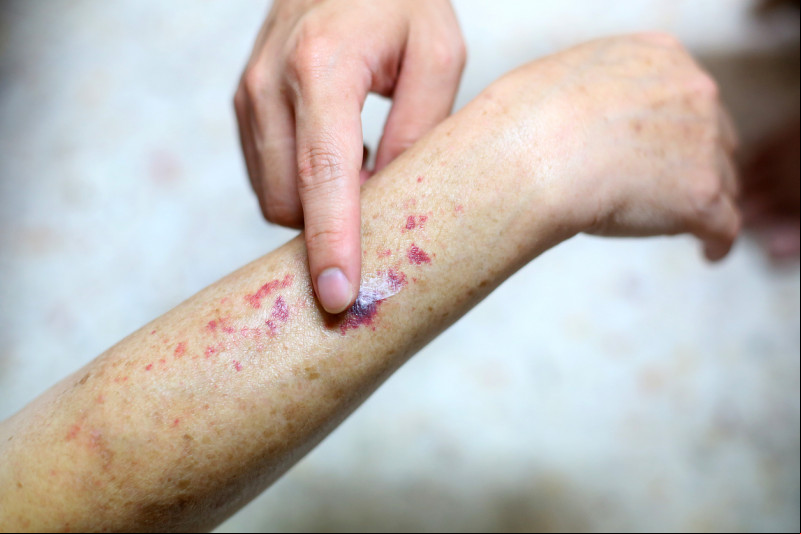 Sintomas de leucemia incluem manchas pelo corpo - (Getty Images)
