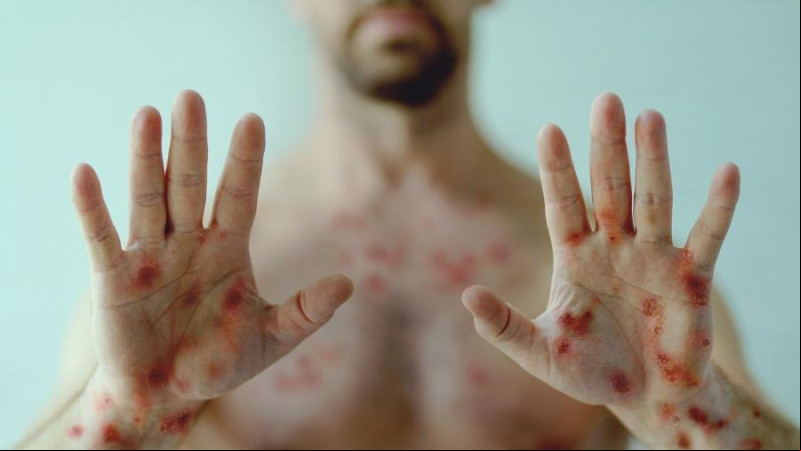 Quem já pegou a catapora também pode ter mpox? - (Foto/iStock)